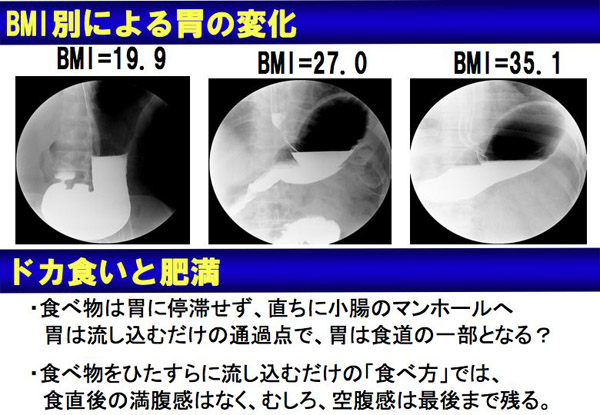 BMI別による胃の変化、ドカ食いと肥満